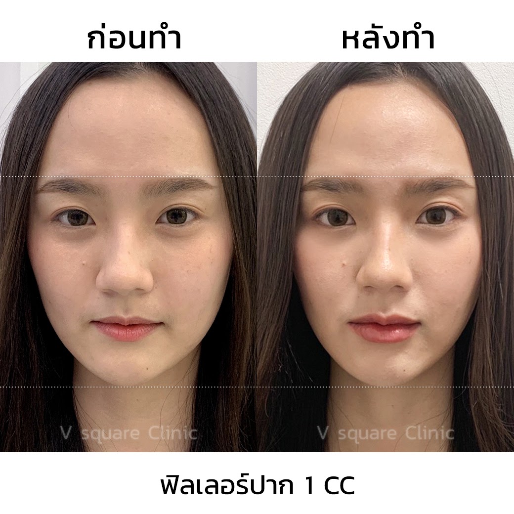 รีวิวฉีดฟิลเลอร์ปาก2