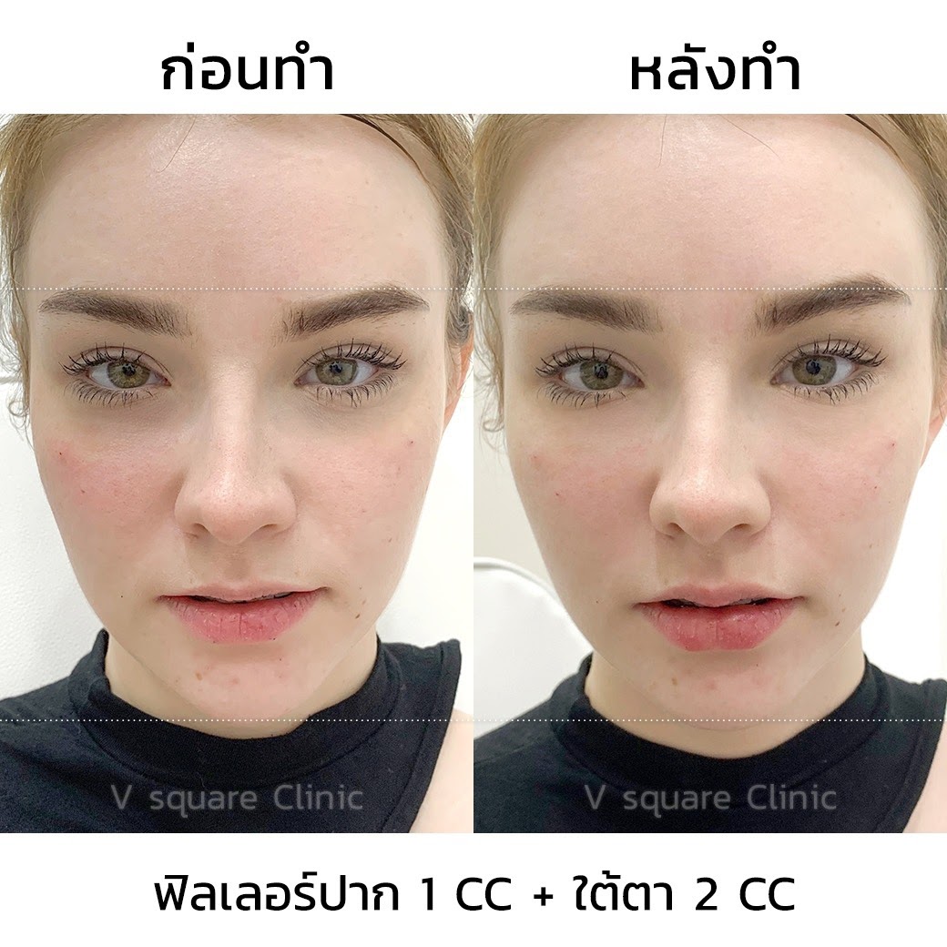 รีวิวฟิลเลอร์ปาก