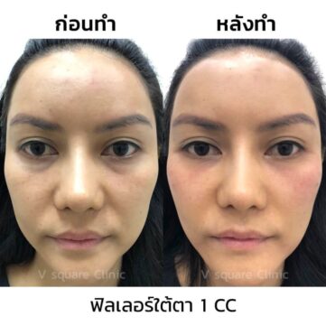 รีวิวฟิลเลอร์ใต้ตา1cc