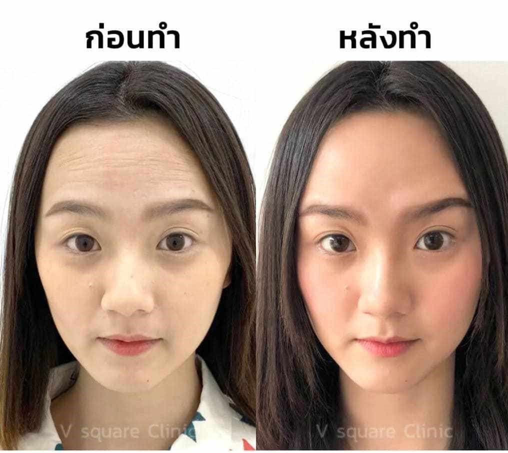 ฟิลเลอร์หน้าผาก