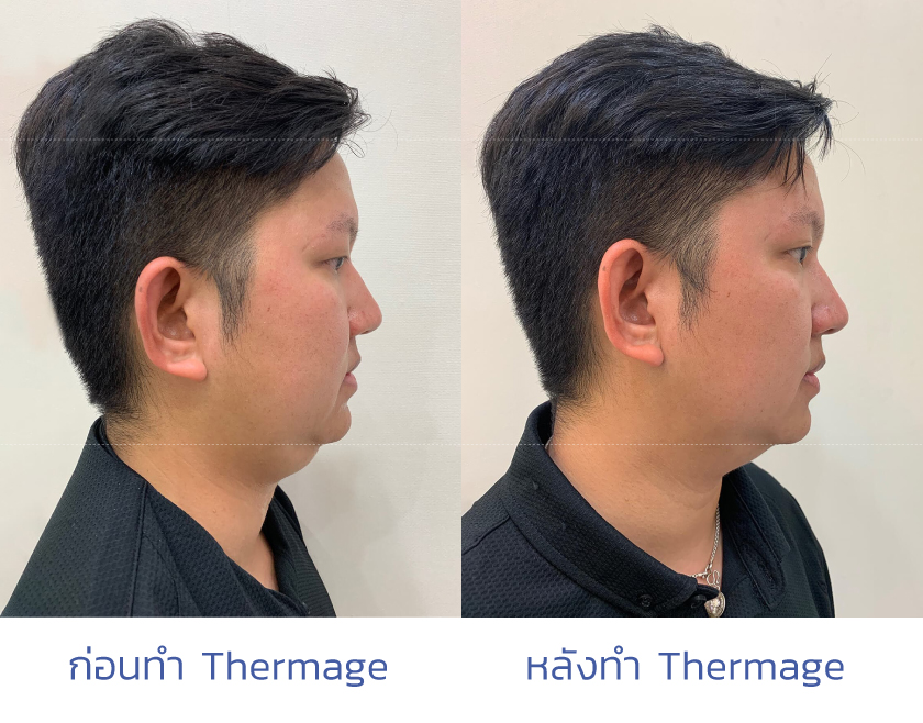 thermage คืออะไร